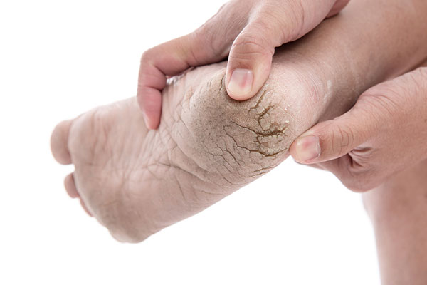 Dry and Cracked heels? Causes and treatment | DU'IT Skincare