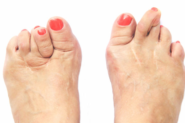 Claw & Hammer Toes - Wanneroo Podiatry